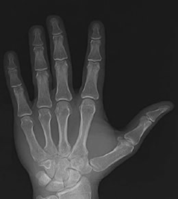 Radiografia da mão humana